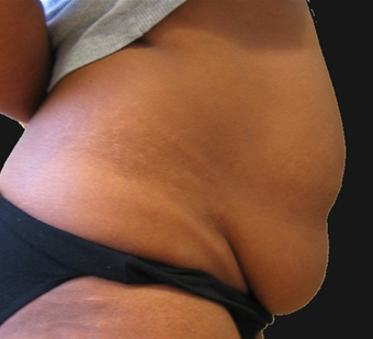 Abdominoplasty 458934