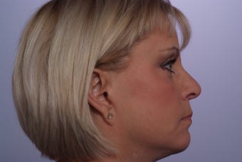 Facelift after 248599