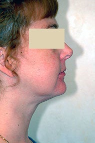 Neck Liposuction after 87336