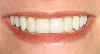 Orthodontics, all porcelain veneers after 503128