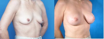 Breast Implants before 223394