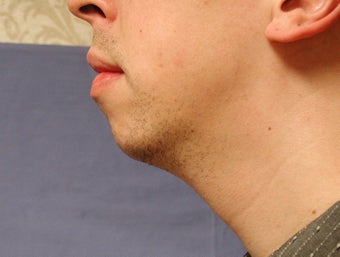 chin augmentation before 408390