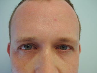 Undereye Filler before 583371