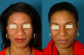 African American Rhinoplasty before 117281