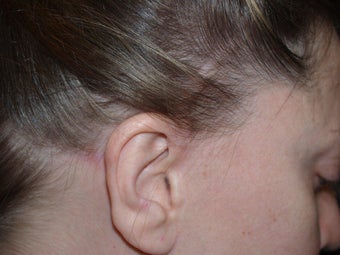Hair Transplant / 850 grafts to temple before 270701