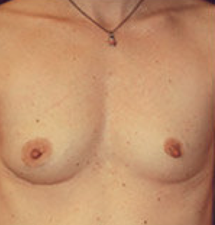 Breast implant removal after 316564