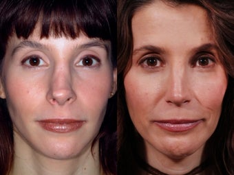 Revision rhinoplasty before 437931