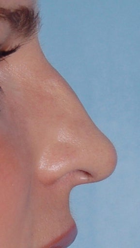 Non Surgical Rhinoplasty before 308291