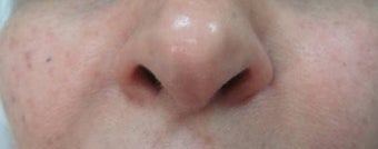Nasolabial Injection after 263053