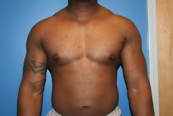 VASER Liposuction for gynecomastia after 507985