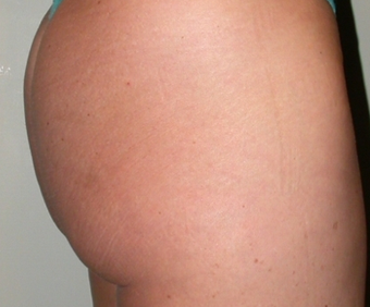 Fat Transfer after 275689