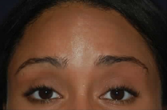 Botox to Treat Horizontal Forehead Lines after 53757
