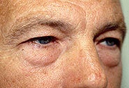 Eyelid Surgery and Brow Lift before 87330