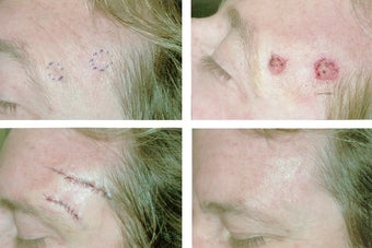 MOHS Skin Cancer Surgery before 369214