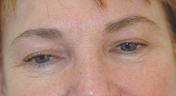 Botox forehead lines (frown lines) after 91313