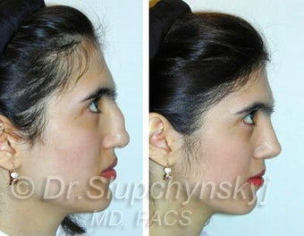 Ethnic Rhinoplasty after 374051