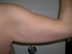 Arm Lift before 259013
