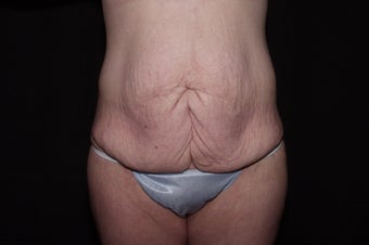 Body Lift before 479774