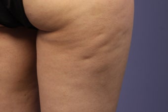 Cellulaze before 576595