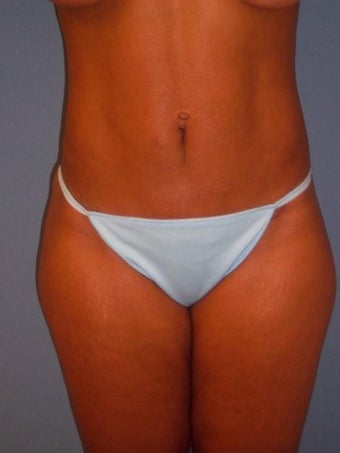 Mini Tummy Tuck 346173