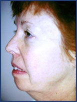 Mid facelift, lower facelift and upper blepharoplasty before 83177