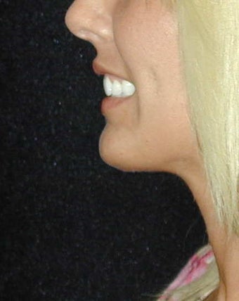 Chin Surgery after 101318
