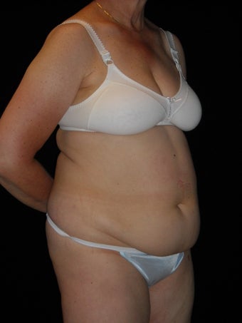 Abdominoplasty 420080