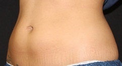 Coolsculpting-lower abdomen before 445738