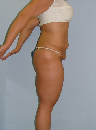Lower Body Lift before 235745