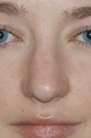 Rhinoplasty before 390972