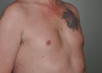 Pec Implants 521679