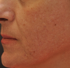 Acne Scarring after 426032