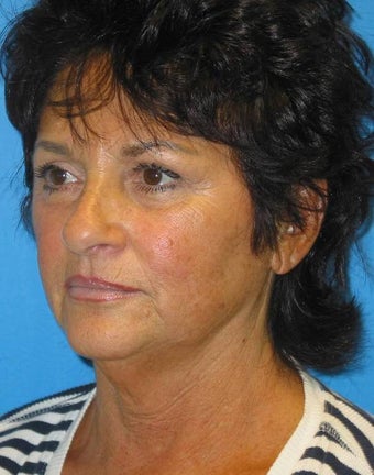 Facelift, 35% TCA peel before 84415