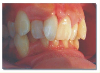 Invisalign for severe crowding/ non extraction 310074