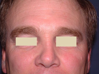 Botox before 93219
