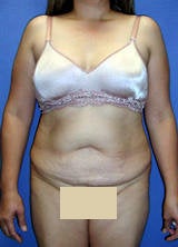 Tummy Tuck (Abdominoplasty) Surgery before 130050