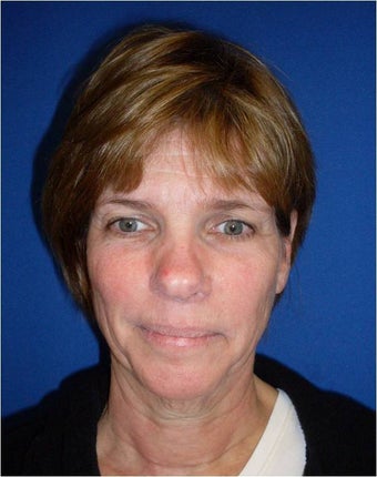 Facelift before 274845
