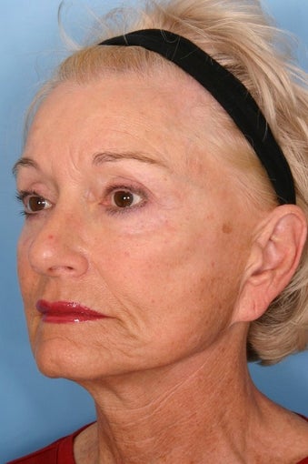 Sculptra Injections for Facial Volume Restoration before 112985