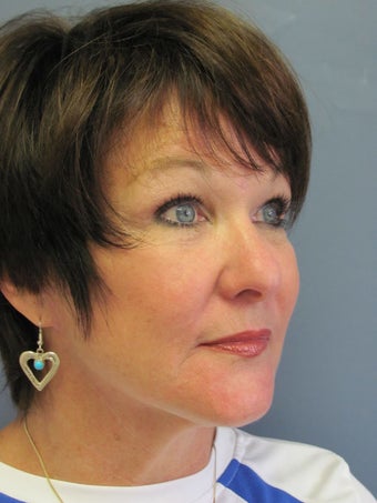 Neck Lift, Platysmaplasty 634733