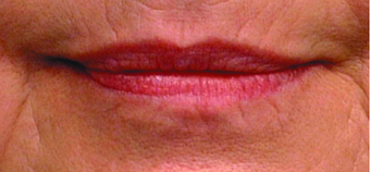 Lip augmentation before 369093