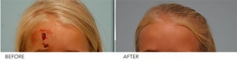 Laceration Repair before 382768