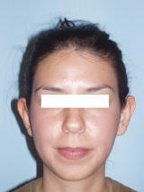 Ear Surgery (otoplasty) before 124881