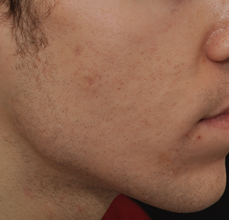 Acne Scarring after 426027