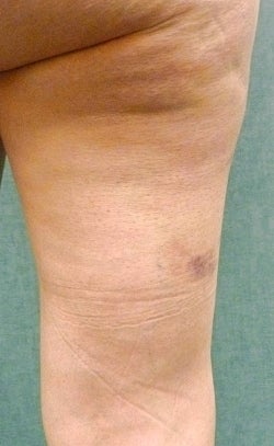 Cellulaze before 582366