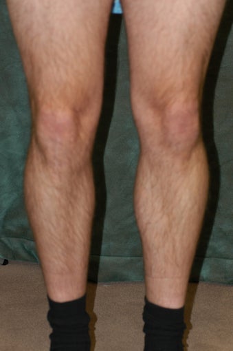 Men's Calf Augmentation 519062