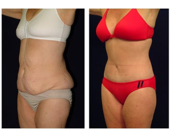 Tummy Tuck or Abdominoplasty before 283083