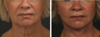 Mini Facelift before 303634