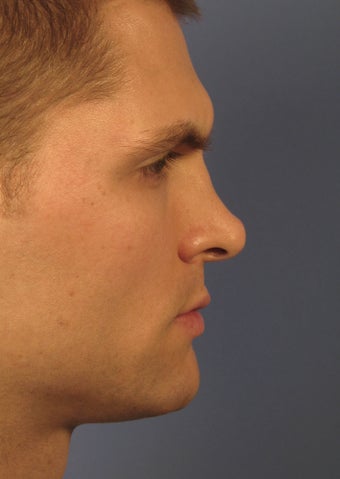 Revision Rhinoplasty 410605