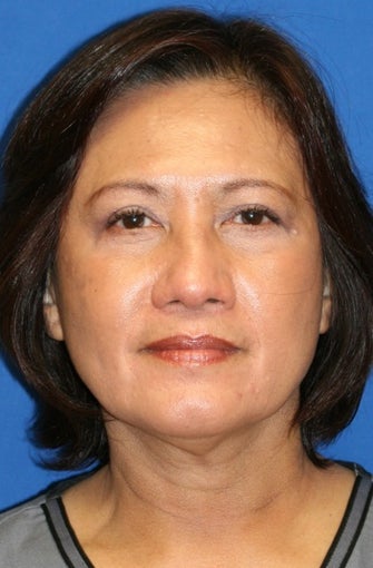 Upper Blepharoplasty,Lower Blepharoplasty, and Lower Eyelid Skin Pinch after 476840
