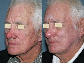 Fraxel repair in conjunction with multiple lasers before 104294